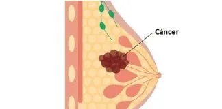 Cáncer de mama: ¿cómo influyen los factores socioeconómicos?