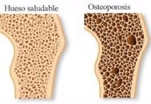 Osteoporosis, la enfermedad de los mayores