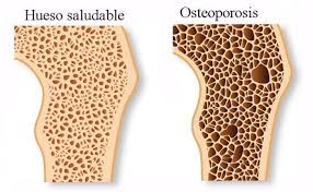 Osteoporosis, la enfermedad de los mayores