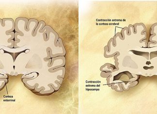 Descargue gratuitamente: «Importancia de los hábitos de vida saludables en la prevención del Alzheimer»